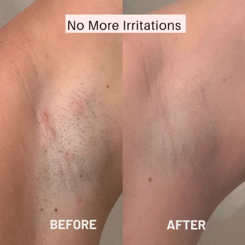 Women's razor trimmer – Smooth skin without irritation 